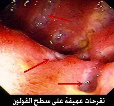 ���� Crohn`s Disease